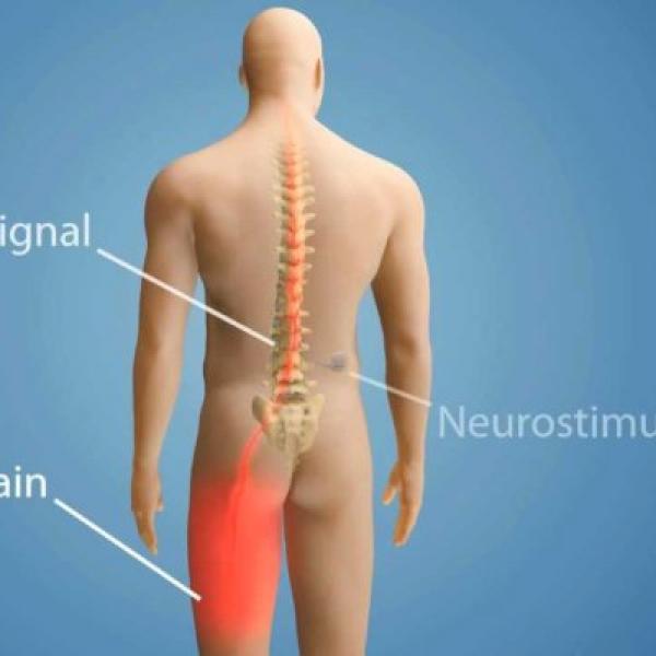 Spinal Cord Stimulation